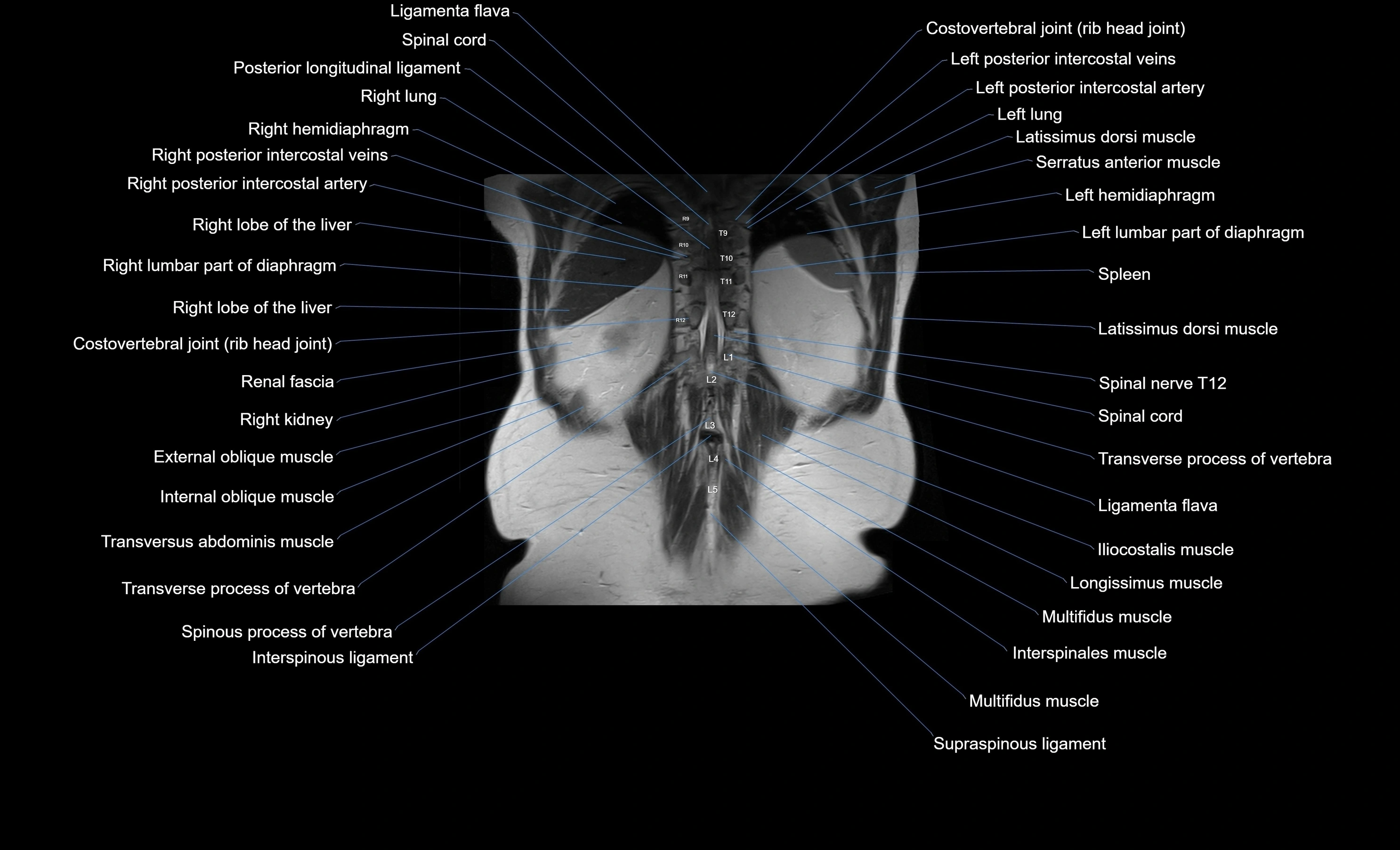 MRI Abdomen coronal labelled cross sectional anatomy radiology  image-img-00001-00049.webp